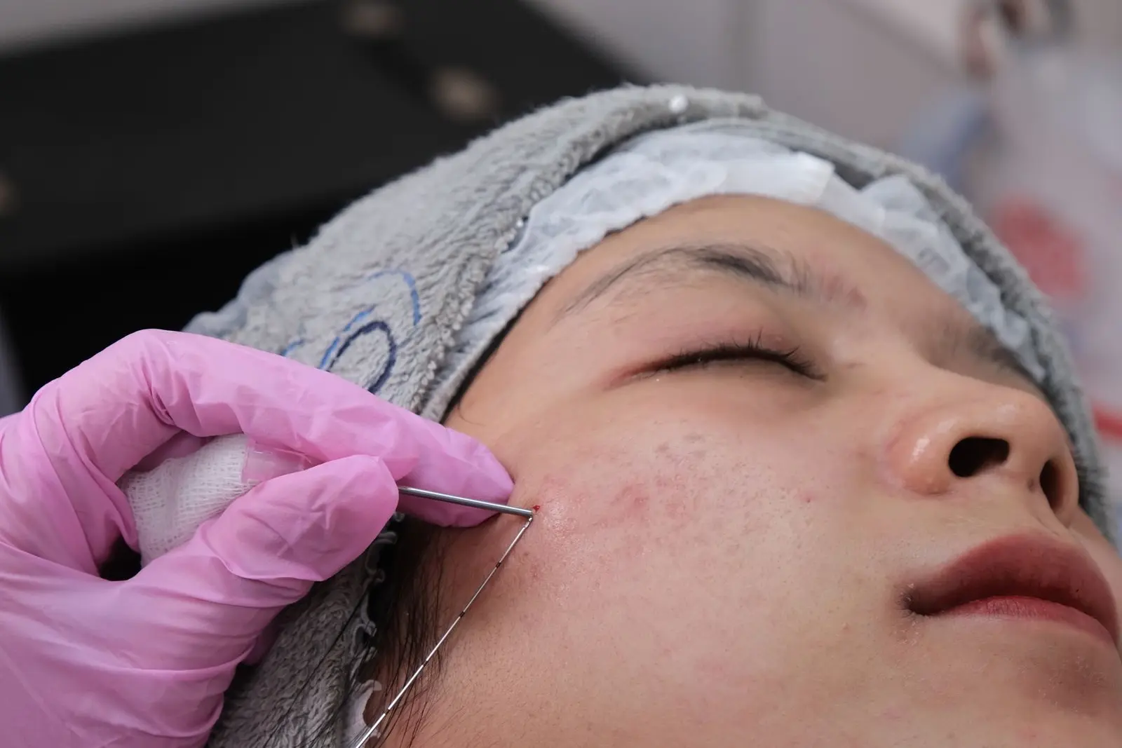 Procedimiento dermatológico para mejorar cicatrices faciales